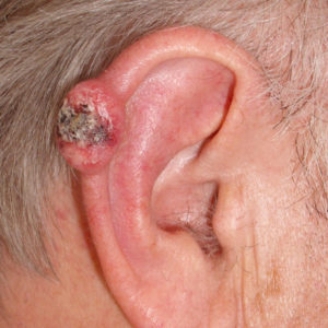 Carcinoma Espinocelular