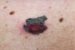 Melanoma